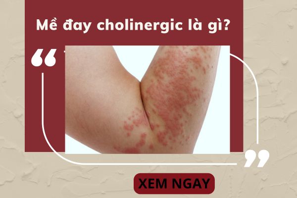 Mề đay cholinergic là gì? Nguyên nhân và cách điều trị